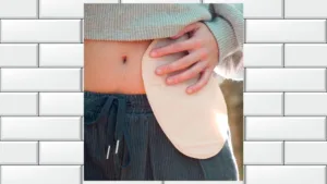 persona ostomizada ostomia