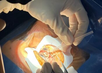 El Hospital Clínico de Valencia incorpora una nueva técnica láser para intervenciones de glaucoma 2 El Hospital Clínico de València incorpora una nueva técnica láser para intervenciones de glaucoma