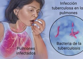 Los casos de tuberculosis disminuyen en España más de un 22% desde 2015