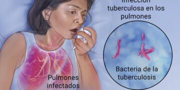 Los casos de tuberculosis disminuyen en España más de un 22% desde 2015