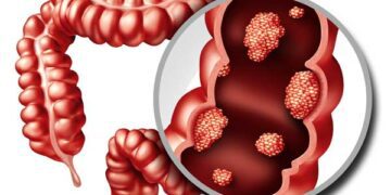 El Departamento de Salud del Vinalopó recuerda la importancia de participar en el programa de prevención de cáncer colon