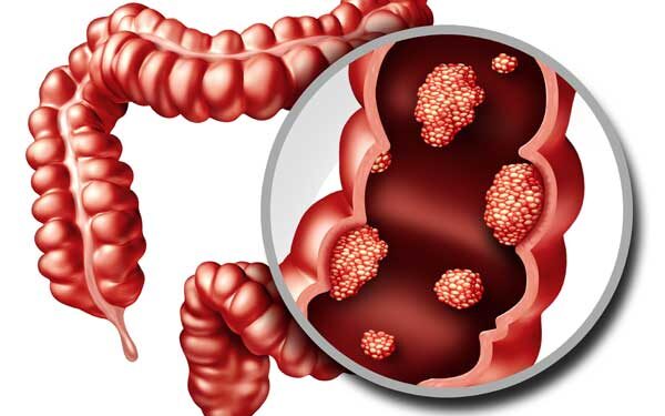 El Departamento de Salud del Vinalopó recuerda la importancia de participar en el programa de prevención de cáncer colon 1 El Departamento de Salud del Vinalopó recuerda la importancia de participar en el programa de prevención de cáncer colon