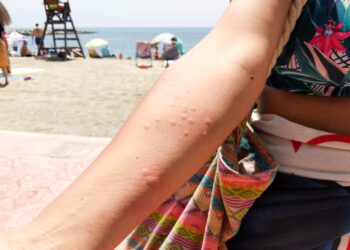 Expertos de Vithas señalan cómo actuar en casos graves ante una picadura de medusa