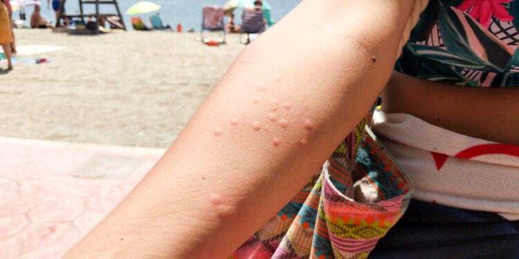 Expertos de Vithas señalan cómo actuar en casos graves ante una picadura de medusa 1 Expertos de Vithas señalan cómo actuar en casos graves ante una picadura de medusa