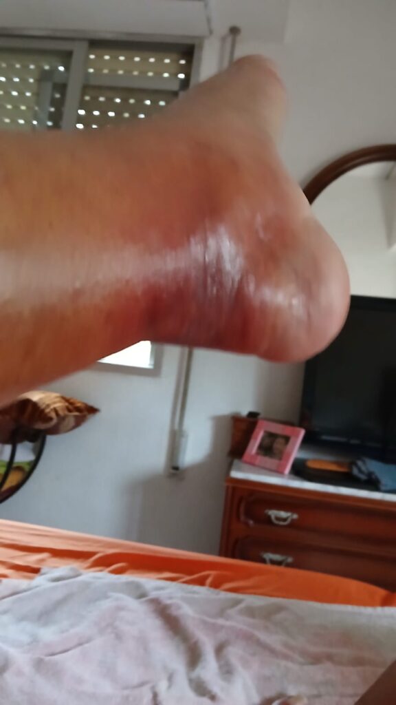 La araña violín: una plaga silenciosa en Náquera, Bétera y Serra 5 La arana violin una plaga silenciosa en Naquera Betera y Serra 1