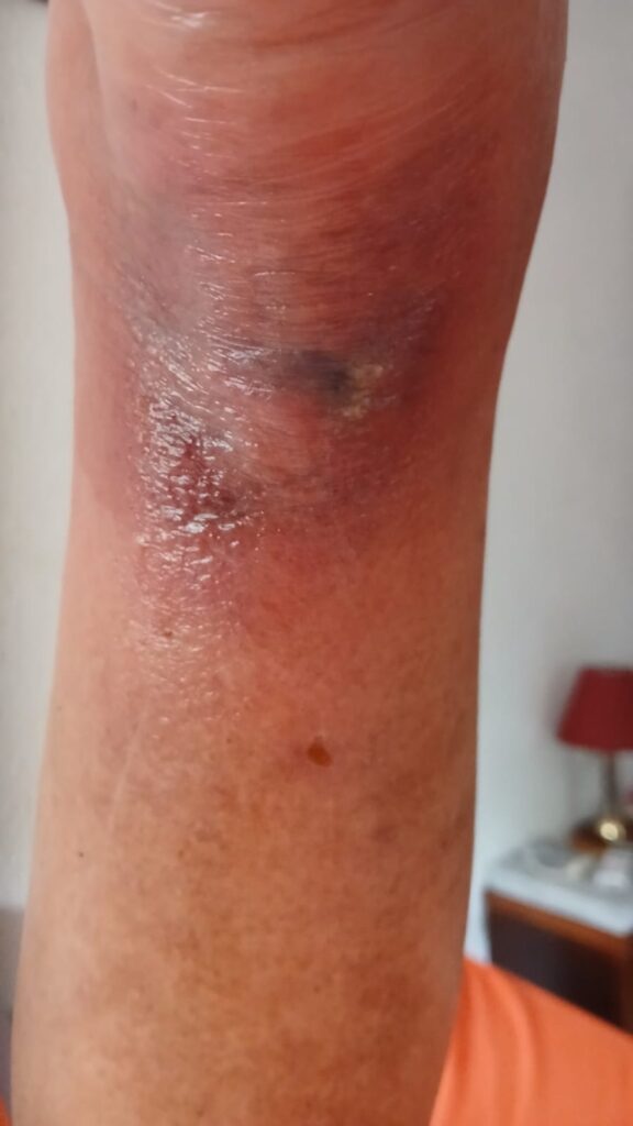 La araña violín: una plaga silenciosa en Náquera, Bétera y Serra 3 La arana violin una plaga silenciosa en Naquera Betera y Serra 3