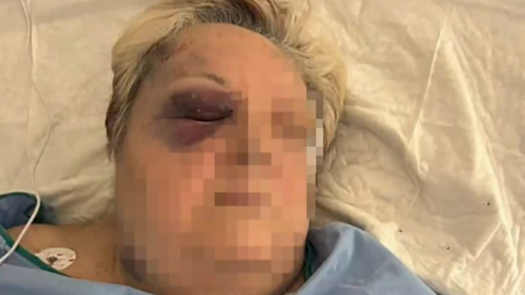Una mujer de 71 años, brutalmente agredida en plena calle en Campanar tras un intento de robo 3 Brutal agresion a una mujer de 71 anos en Campanar dos individuos en patinete la golpearon hasta dejarla inconsciente 1