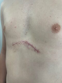 "La primavera es el punto de inflexión": el Hospital Vithas Valencia Consuelo impulsa el abordaje integral de las deformidades torácicas en adolescentes 3 04642e32 8a37 4e39 8cce 7e8ce97faf90 rotated