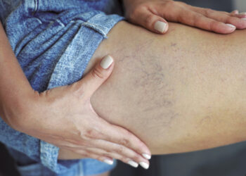 Especialistas de Vithas en la Comunidad Valenciana alertan del aumento de patologías venosas y recuerdan que no son solo un problema estético