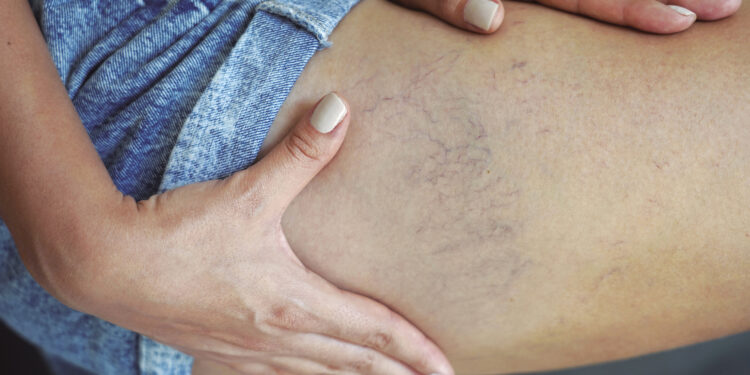 Especialistas de Vithas en la Comunidad Valenciana alertan del aumento de patologías venosas y recuerdan que no son solo un problema estético 1 Especialistas de Vithas en la Comunidad Valenciana alertan del aumento de patologías venosas y recuerdan que no son solo un problema estético