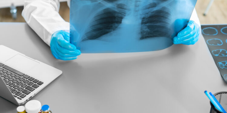 Un nuevo decálogo médico busca frenar el infradiagnóstico del Déficit de Alfa-1 Antitripsina (DAAT)