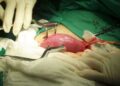 programa transplante higado