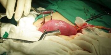 programa transplante higado