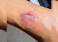 Detenida una conductora en Pilar de la Horadada por circular en sentido contrario y morder a un agente de la Policía Local 10 el mordisco dejo en el brazo del agente una visible marca 16 9 aspect ratio default 0 da39
