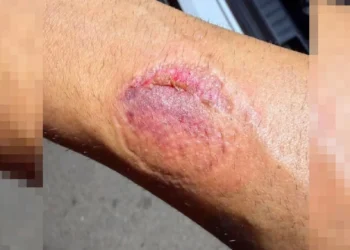 Detenida una conductora en Pilar de la Horadada por circular en sentido contrario y morder a un agente de la Policía Local 14 el mordisco dejo en el brazo del agente una visible marca 16 9 aspect ratio default 0 da39