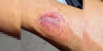 el mordisco dejo en el brazo del agente una visible marca 16 9 aspect ratio default 0 da39