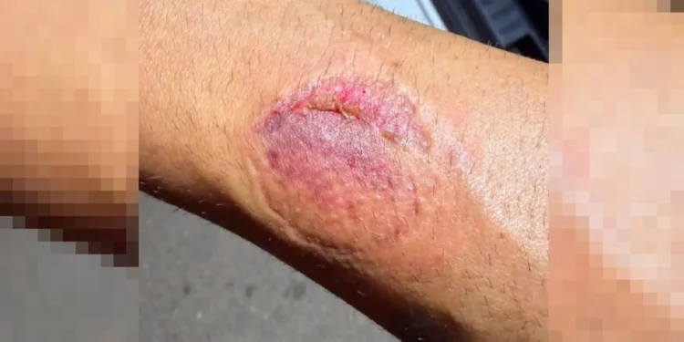 el mordisco dejo en el brazo del agente una visible marca 16 9 aspect ratio default 0 da39